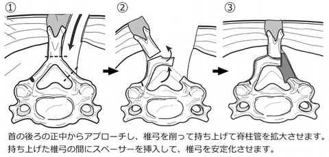 頚椎椎弓形成術を受ける方へ