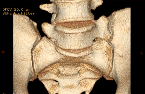 まれな腰痛疾患①Bertolotti症候群について