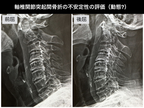 ハングマン骨折（軸椎関節突起間骨折）の不安定性の評価の方法って？