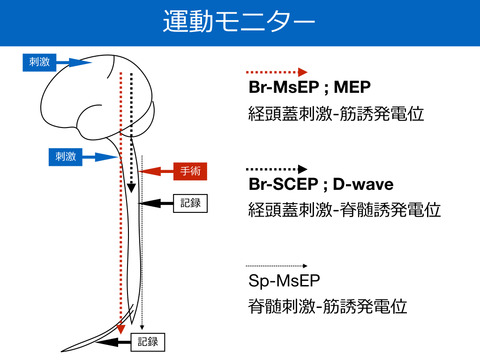 運動モニター、MEPとD-waveについて