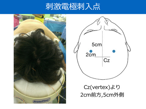 MEPの経頭蓋刺激電極の刺入点について