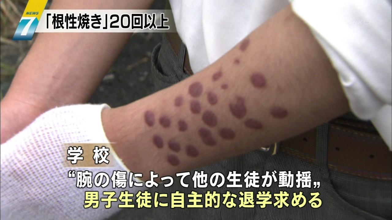 仙台でおきたヒドすぎる 根性焼き のイジメ Torimind Life 仙台でおきたヒドすぎる 根性焼き のイジメ Torimind Life