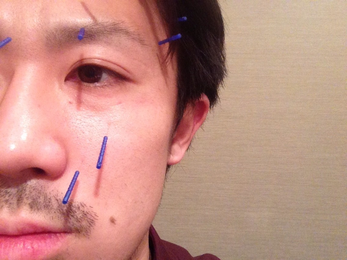 美容鍼の細さ 美容鍼 美顔鍼 美容針 美顔針 エステサロン 大阪 東淀川 阪急淡路駅前 Face To Faceフェイストゥフェイス のブログ