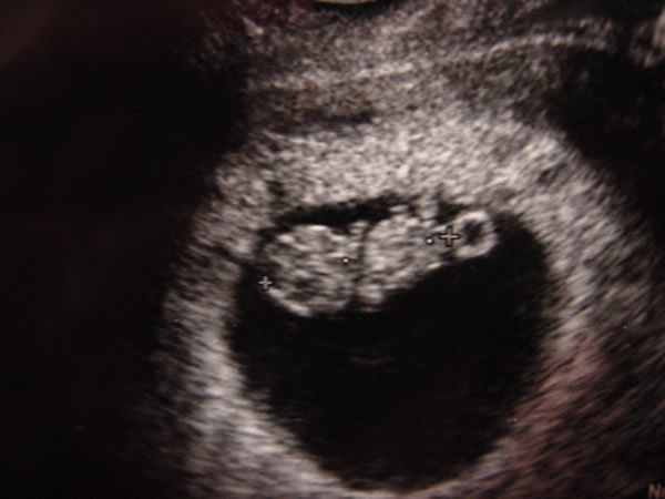 妊娠８週通院日 キラキラ ふぉーてぃー ニコニコ ｖ 体外受精 顔晴る高齢出産への道