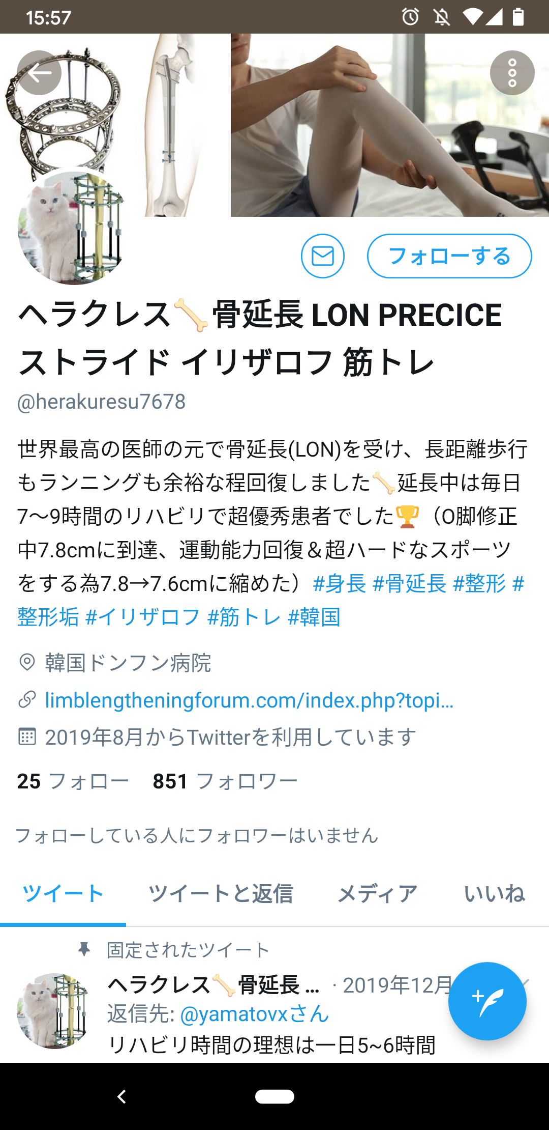 骨延長手術で身長を伸ばすのが流行り始めてる ガハろぐnewsヽ W ズコー 骨延長手術で身長を伸ばすのが流行り始めてる ガハろぐnewsヽ W ズコー