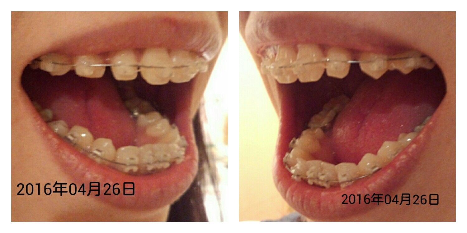 矯正 サリーの記録