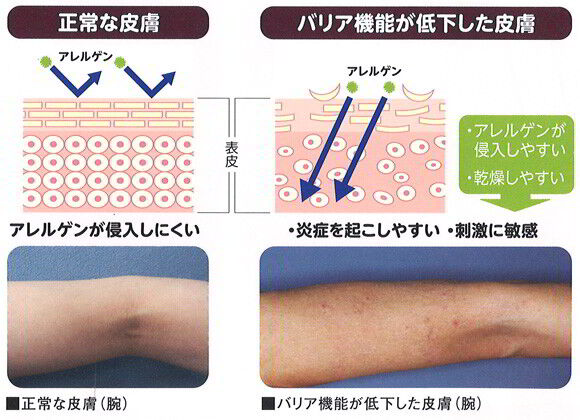 自然派妻の地獄のようなアトピー治療を受ける男性「来年あたり死にそう」