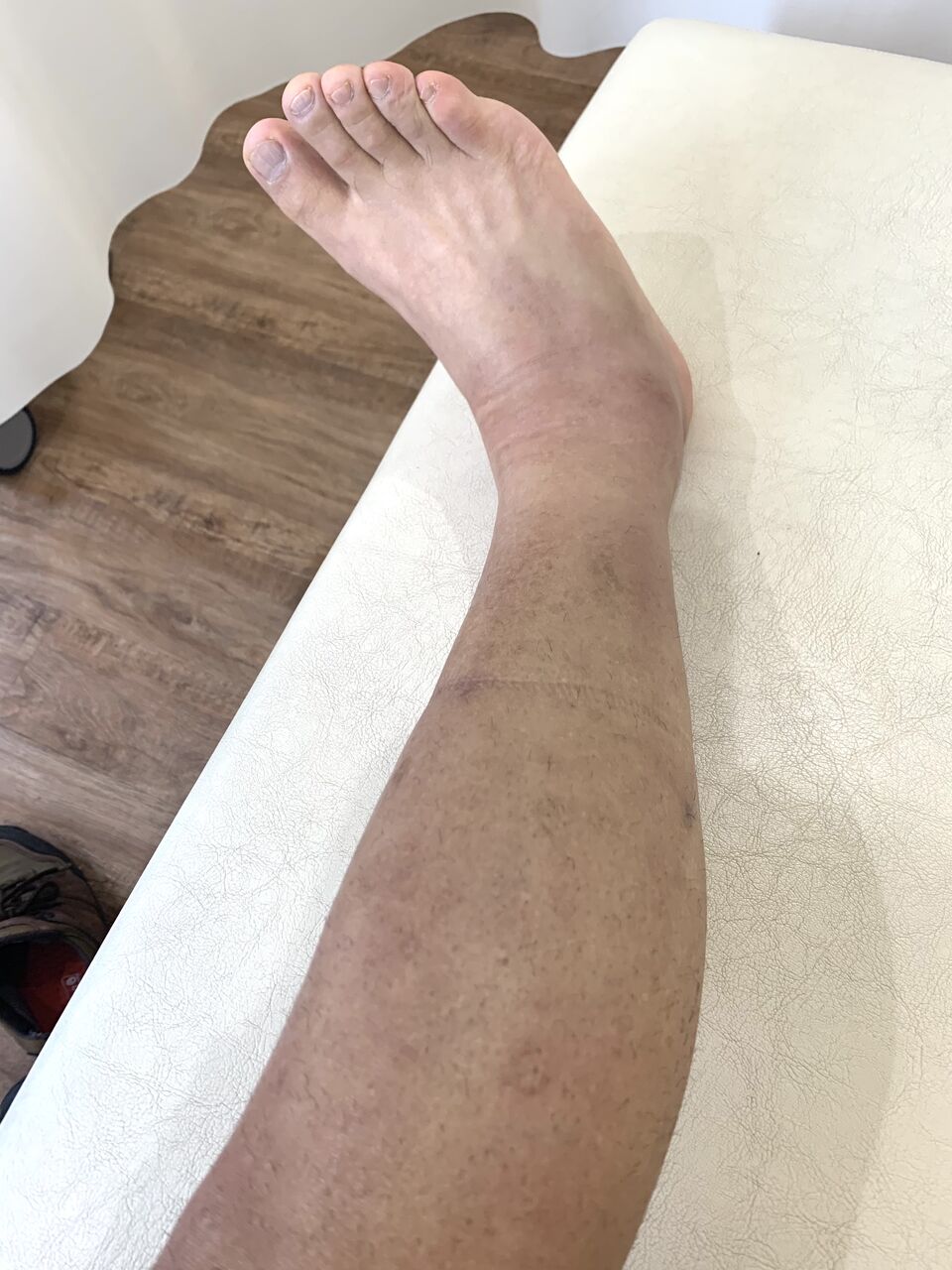 まさかの腓骨骨折 ふつうのパパ の部屋