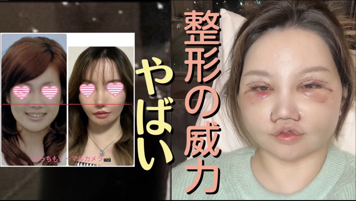 【中傷】高校3年生、整形YouTuberを誹謗中傷”ダイナ巨人”…学校特定され詰む