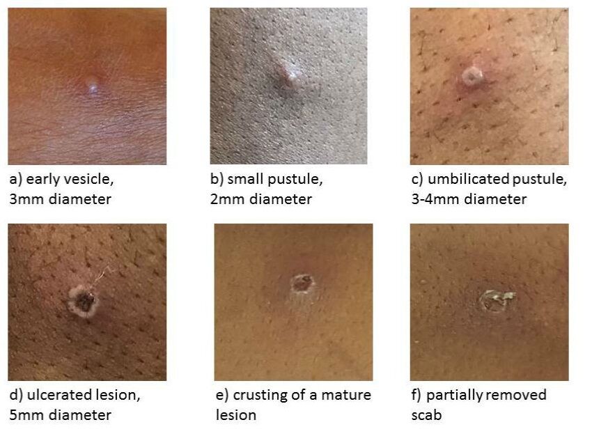 1-monkeypox_individual_lesions_v3_960x640
