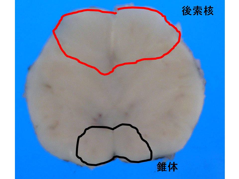 知覚性上行伝導路は3個のシナプスを形成 延髄にも第2次ニューロンが存在する 感染症の病理学的考え方