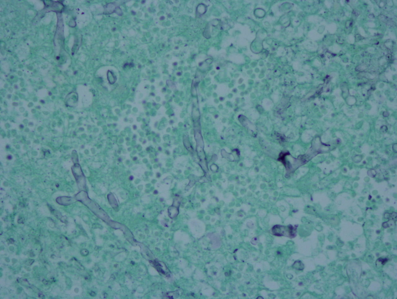 感染症の病理学的考え方
	  接合菌症の病理はムコール目までの同定に留まる
	コメントトラックバック                        砂川恵伸