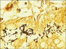 ワルチン スターリ染色は銀を用いる 感染症の病理学的考え方
