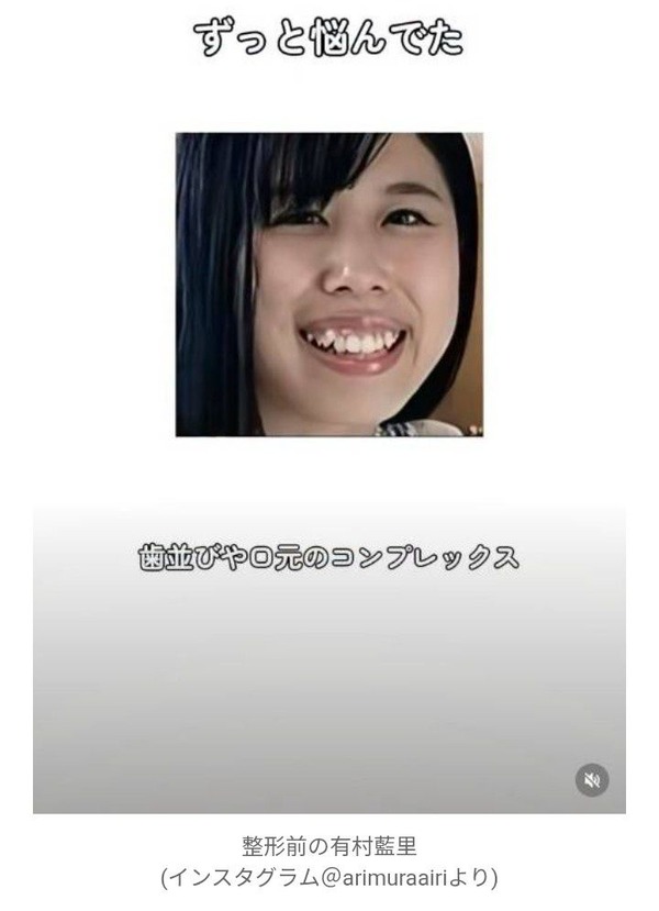 「可哀相」「そりゃ整形したくなる」と心無い声　有村架純の姉・有村藍里、整形前の顔を公開