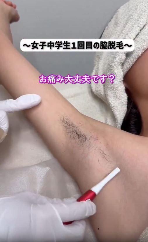 JCの脇毛脱毛動画がエロ過ぎる
