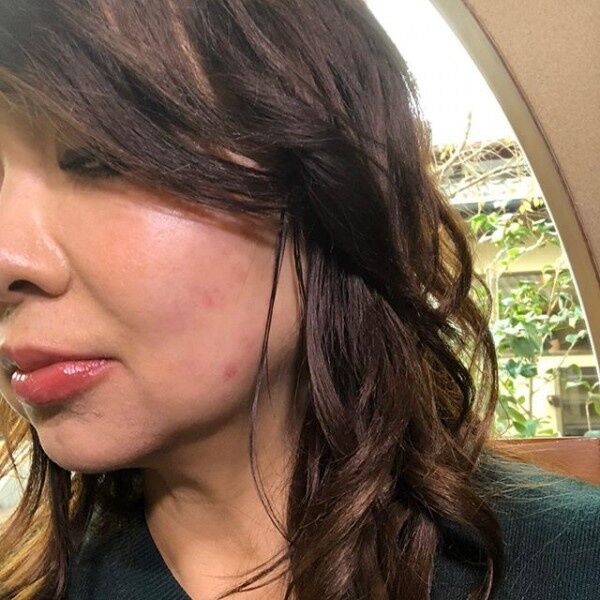 芸能 ハイヒール モモコ 頬が赤く腫れあがった写真を公開 発症から1年 まだ痛いまま と告白し反響 芸能とくダネ 芸能 ハイヒール モモコ 頬が赤く腫れあがった写真を公開 発症から1年 まだ痛いまま と告白し反響 芸能とくダネ