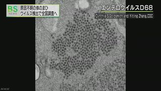 【エンテロウイルスD68】子どもが原因不明のまひ…21都府県で47人　 国立感染症研究所が全国調査へ