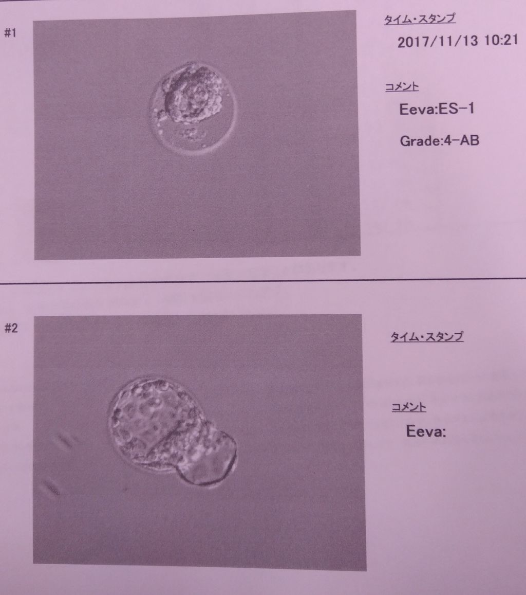 D24 凍結胚盤胞移植 Chibi Come Blog