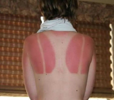 girl-bad-burn