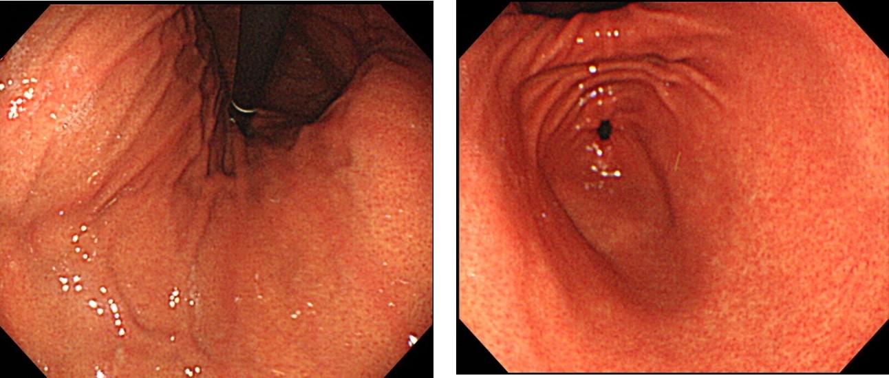 若い人のピロリ感染の胃 地方内視鏡医のカメラ画像