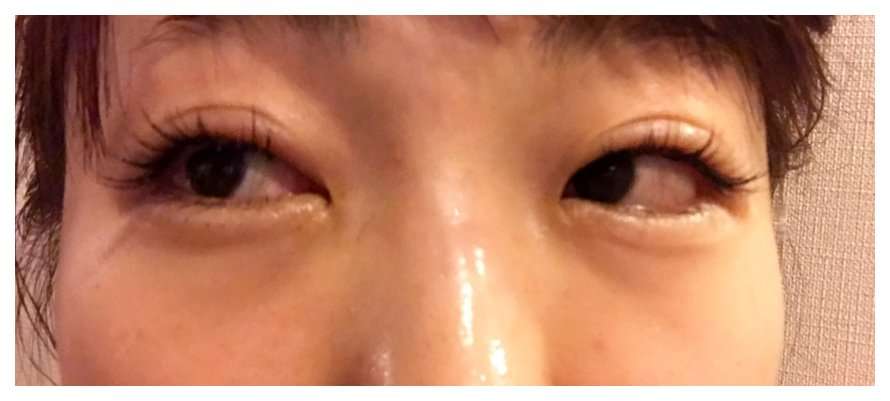 整形公表の あいのり 桃 埋没法の目は泣くとこうなる 腫れた目元を公開 がーるずとーく 整形公表の あいのり 桃 埋没法の目は泣くとこうなる 腫れた目元を公開 がーるずとーく