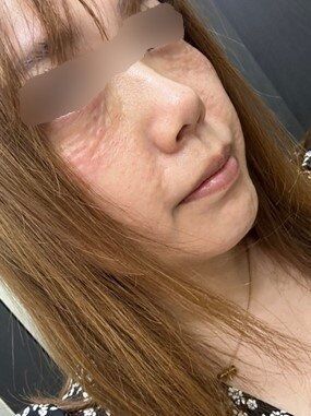 〈“デメキン涙袋”女性のその後〉今度はサーモンの成分を目元に注入「美容整形はこりごり。今は再生治療にハマってます」月収12万円も「老けたくない」