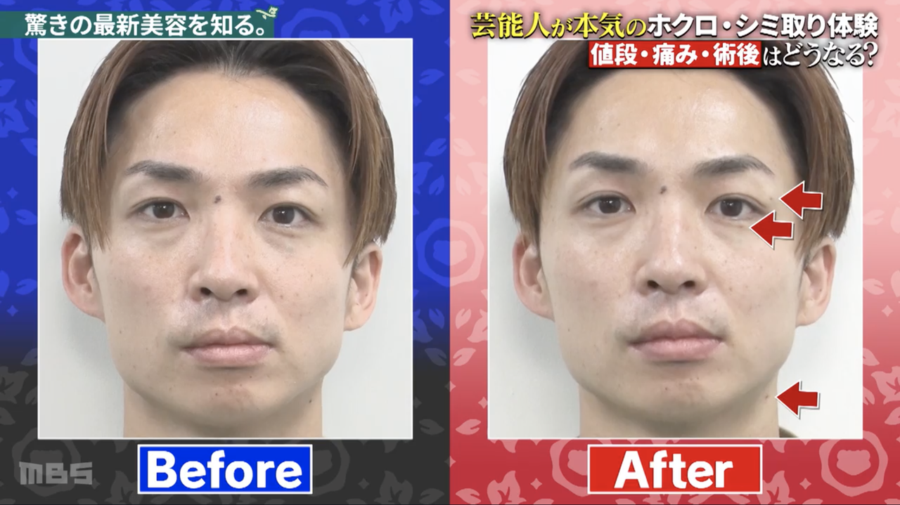 「アインシュタイン」河井ゆずる、1ミリあたり1万780円でほくろ除去「なんの痛みもなかった」