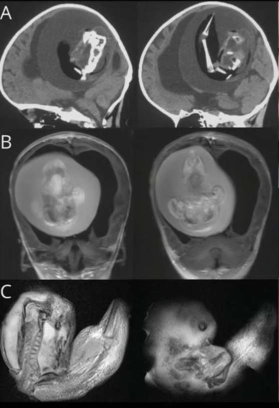 赤ちゃんの頭蓋骨に双子の胎児…腕はもちろん爪まで
