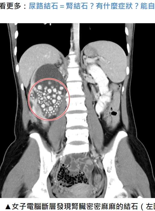 「水をほとんど飲まなかった」20歳女性の腎臓から300個以上の結石を回収（台湾）