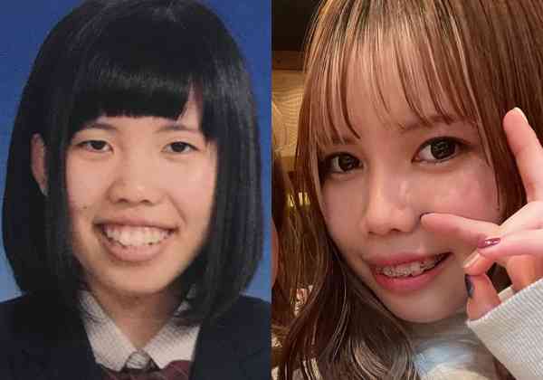 【整形美女】顎変形症の女性が整形で得たものとは？ 「努力して可愛くなったんだね」自尊心を保てた彼氏からの言葉