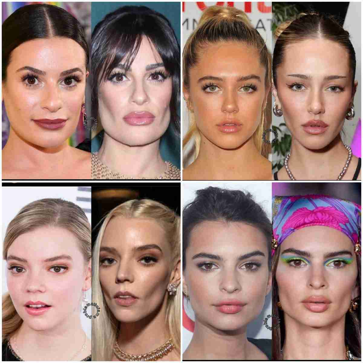 30分で垂れ下がった頬が若返る？セレブがハマる美容整形「バッカルファット除去」魅力とリスク