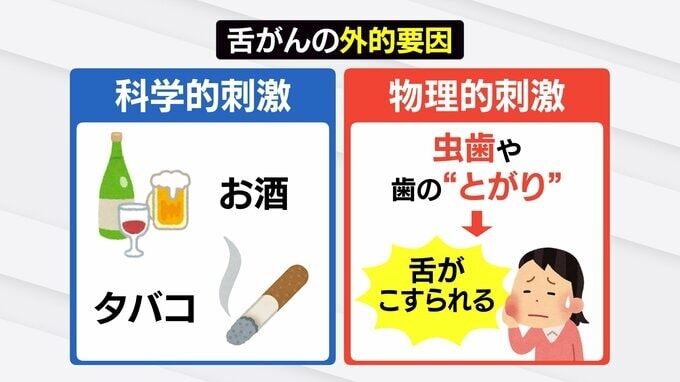 20年で2倍…増える若年層の「舌がん」 現代人特有の “狭い歯並び” が引き金に? 口内炎との決定的な違いとは