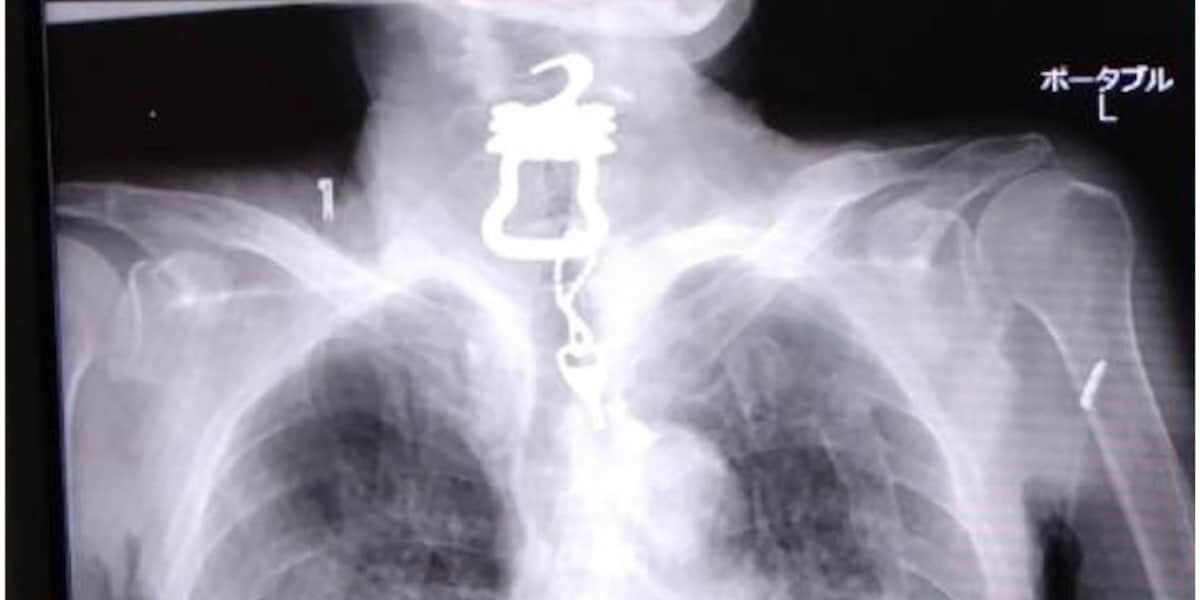 ”キーホルダー付き鍵”がのどに…　新型コロナ感染後に死亡も、深まる疑念　「納得できる説明をしてほしい」と遺族