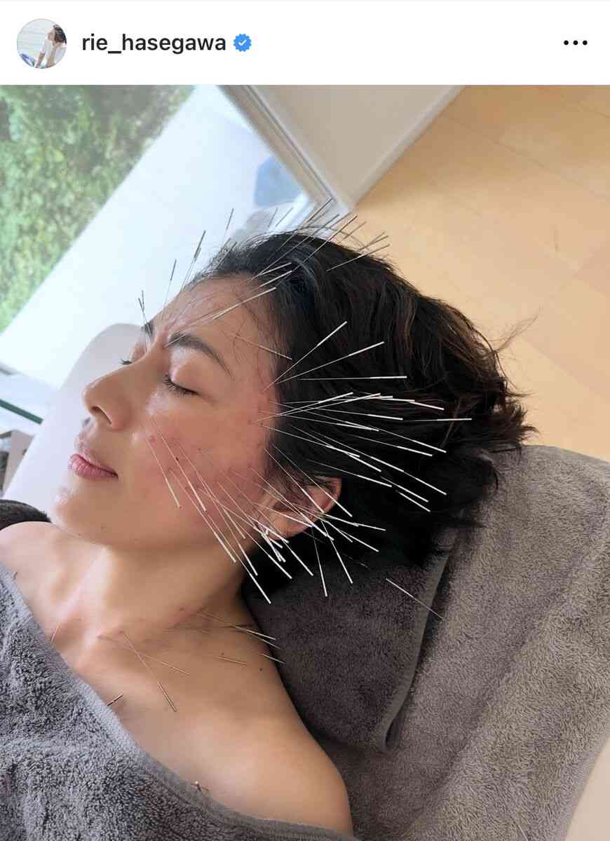 50歳・長谷川理恵、「見た目ほど痛くないです」顔面に針!? 治療の効果はコリが「うそみたいにすっきり」