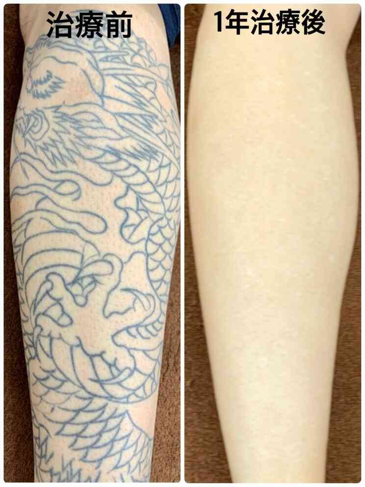 タトゥー・刺青除去専門医が明かす患者の十人十色なワケアリ事情…「推し変したので消したい」「憎い人間を足裏に入れて毎日踏んだけど…」