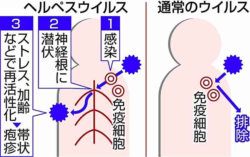 新型コロナウイルス、体内から追い出せず後遺症？感染後に潜伏するヘルペスと類似　大阪大教授が指摘