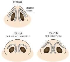 鼻の整形について