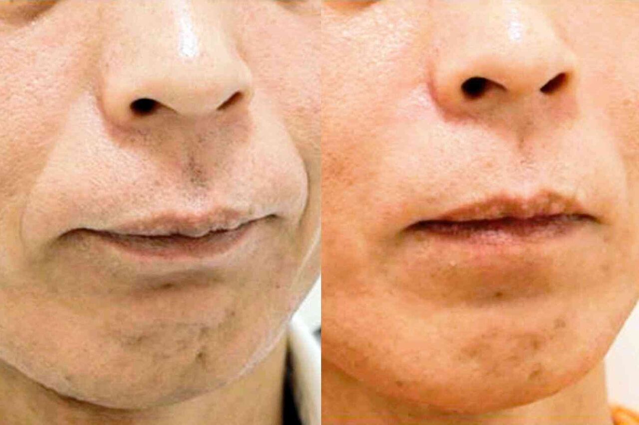 「薬剤注入で顔がボコボコに」　やってはいけない美容外科選び　中高年も踏み出す「プチ整形」