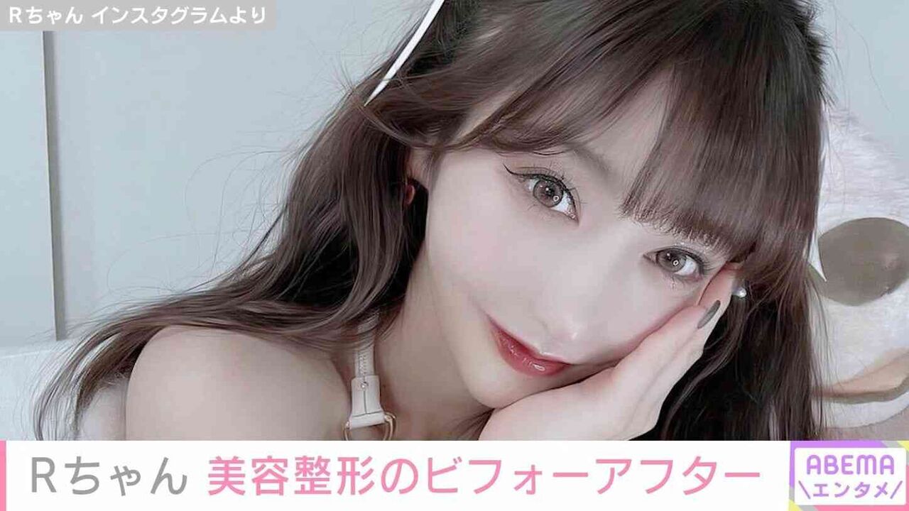 “整形総額約2000万円”Rちゃん「実は整形してたんだけど気づいた？」新たな施術のビフォーアフターを公開