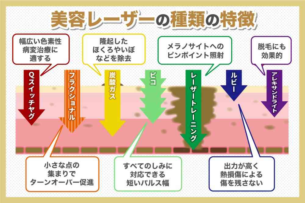 シミ取りレーザーしたことある人