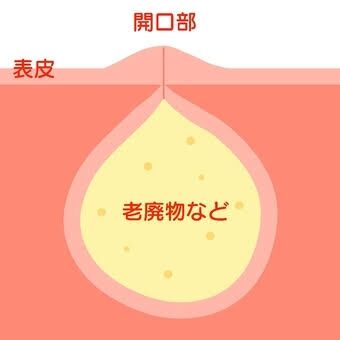 粉瘤ができたことある人！