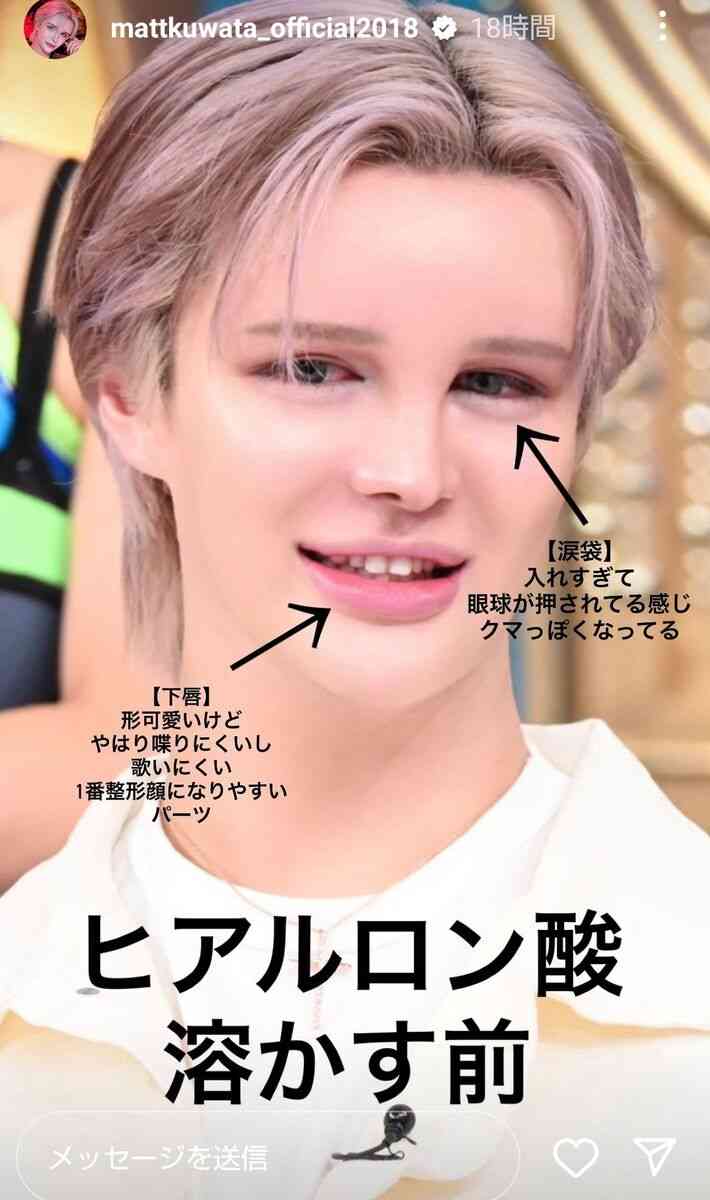 Matt、激変のビフォーアフターに仰天！「明らかに…」「目が大きくなった」美容施術でガラリ