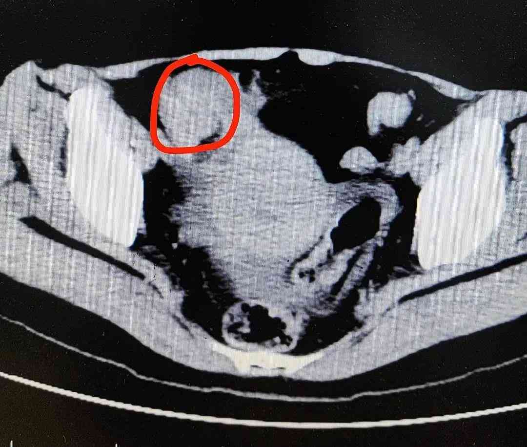 柿を一度に3個食べ腸を5センチ切除　中国人女性