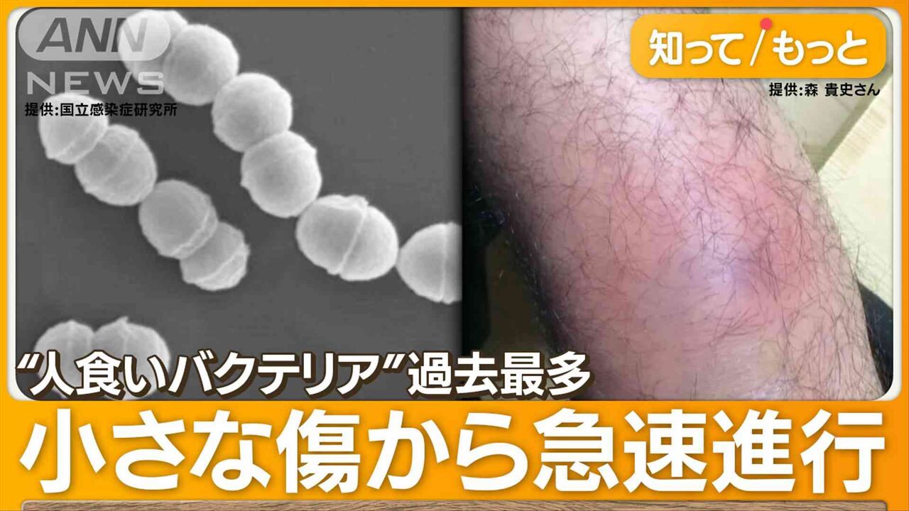 “人食いバクテリア”過去最多　致死率3割…「死を覚悟」片足失った男性　感染経路は