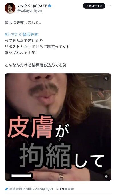 人気インフルエンサー・カマたく　200万円の鼻整形も、失敗を報告「感染症を引き起こし、皮膚が拘縮」