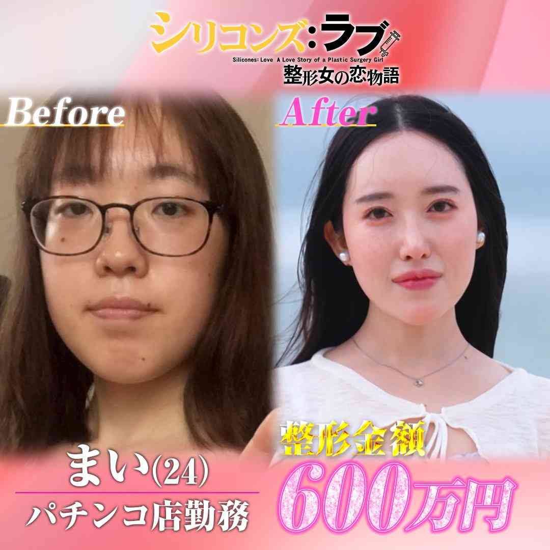 整形総額600万円…24歳女性が語る世間の偏見や自身のコンプレックス 終わりのないループに涙「次から次に気になって…」