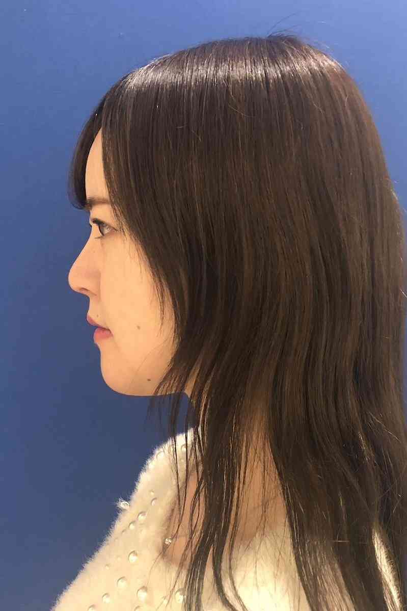 整形アイドル轟ちゃん、整形＆ダイエットで“無加工横顔”ビフォーアフターに反響相次ぐ