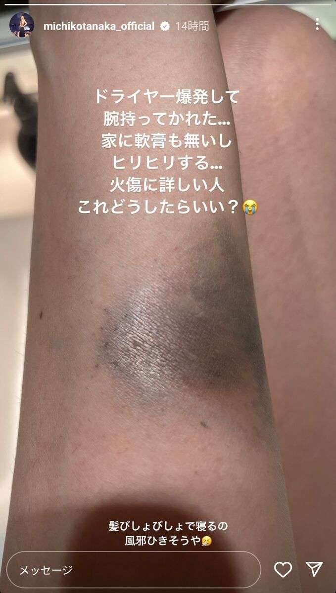 田中道子、「ドライヤー爆発…」でやけど…黒ずんだ腕の写真公開→朝一病院へ　フォロワーのアドバイスに感謝