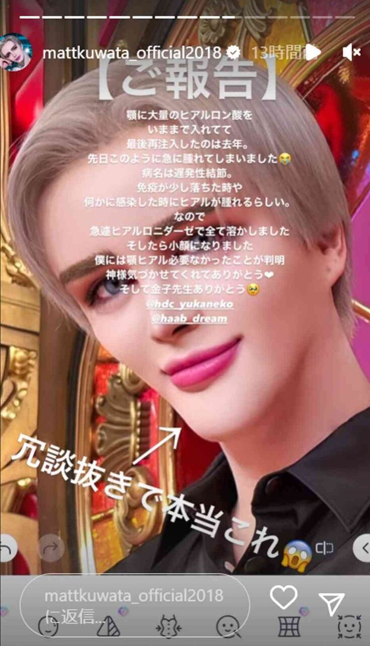 Matt、アゴにヒアルロン酸大量注入で異変→遅発性結節に　現在は思わぬ変化「入れ直して…いい感じ」