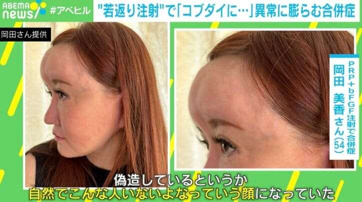 “若返り注射”でおでこが膨らみ「コブダイ」に！？ 当事者「よくこれで生きてたな。額の限界を感じた…」 PRP＋bFGFとは？